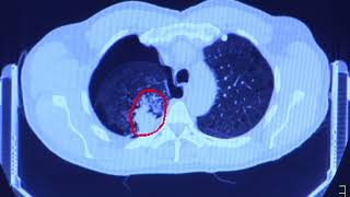 CT Lung Screening