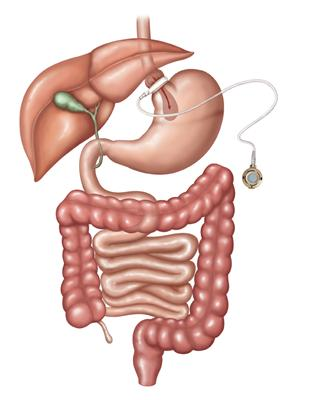 Adjustable Gastric Banding