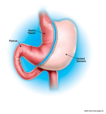 Sleeve Gastrectomy